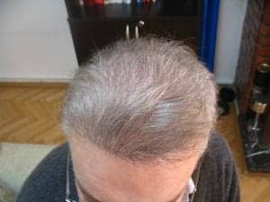 Fue Hair Transplant Cost