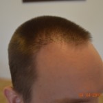 before, plugy hairline, wrong winkles, multi grafts in the hairline