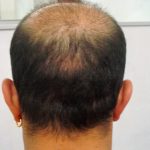 Haartransplantation Resultate