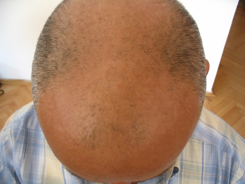 Hair Transplant Results Before and After | HLC Hairline Clinic