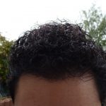 Hair Transplant After 12 Months