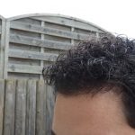 Hair Transplant After 12 Months