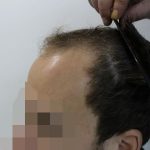 Haartransplantation Ergebnisse