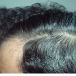 Hair Transplant After 8 Month