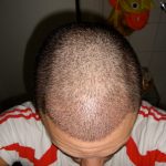 Hair Transplant After 5 Days