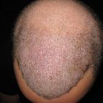 2500 grafts from Donor Scalp