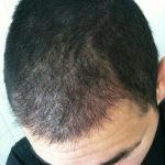 Hair Transplant After 2 Months