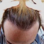 Hair Transplant After 10 Months