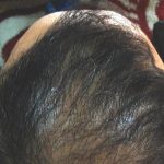 Haartransplantation Verbessern
