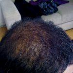 Haartransplantation Korrektur