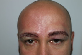 eyebrow transplant post op